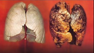 pulmón sano y pulmón de un fumador