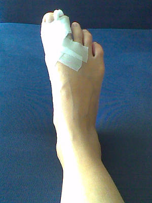 Las lesiones en los pies son muy comunes.