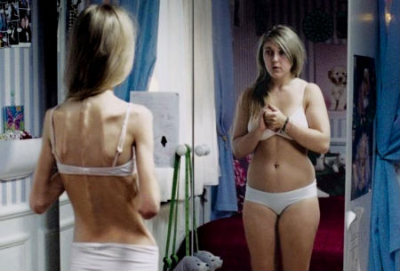 anorexia