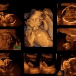 El Cunqueiro impulsa en Vigo una técnica para detectar cardiopatías en bebés antes de nacer